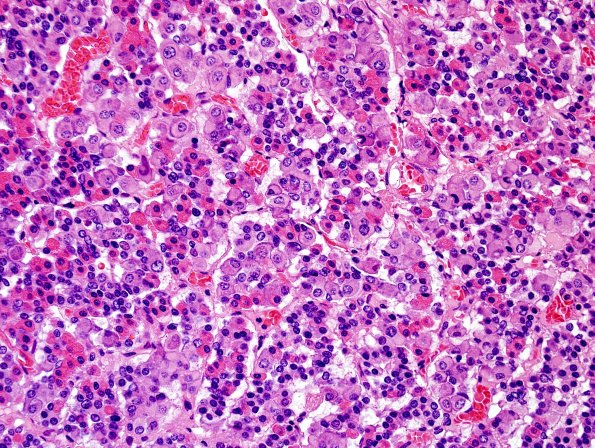 1D2 Empty Sella Syndrome (Case 1) Crooke's change H&E 2.jpg