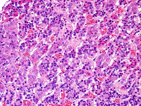 1D3 Empty Sella Syndrome (Case 1) Crooke's change H&E 1.jpg