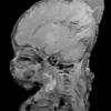 Encephalocele - Complex Malformation