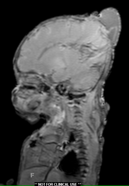 1A1 Encephalocele (A12-143) T1