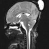 1A2 Encephalocele (A12-143) T2