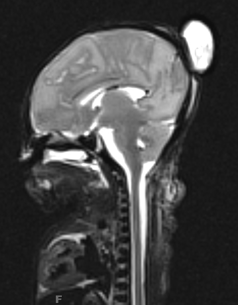 1A2 Encephalocele (A12-143) T2