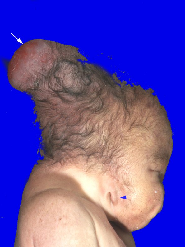 1B1 Encephalocele & Complex Malformation (Case 1) 2A