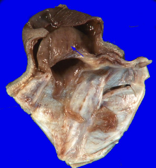 1B2 Encephalocele & Complex Malformation (Case 1) 24A