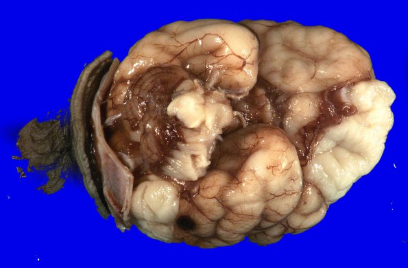 1B3 Encephalocele & Complex Malformation (Case 1) 10A