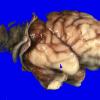 1B4 Encephalocele & Complex Malformation (Case 1) 13A