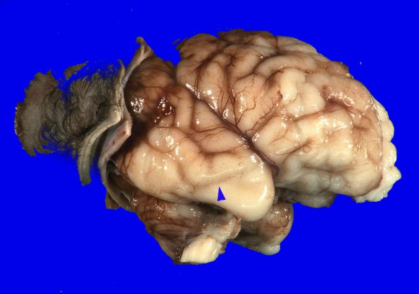 1B4 Encephalocele & Complex Malformation (Case 1) 13A