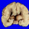 1B5 Encephalocele & Complex Malformation (Case 1) 19A