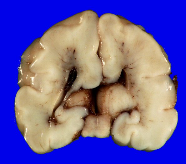 1B5 Encephalocele & Complex Malformation (Case 1) 19A