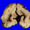 1B6 Encephalocele & Complex Malformation (Case 1) 20A