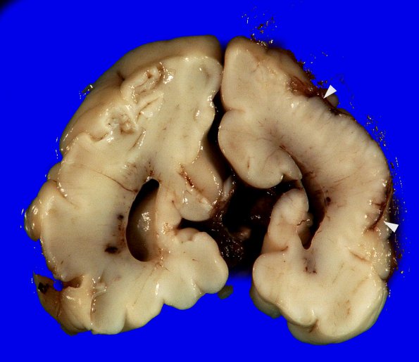 1B6 Encephalocele & Complex Malformation (Case 1) 20A