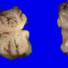 1B7 Encephalocele & Complex Malformation (Case 1) 25A