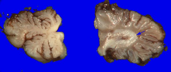 1B7 Encephalocele & Complex Malformation (Case 1) 25A