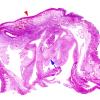 1C1 Encephalocele & Complex Malformation (Case 1) H&E repeat whole mount