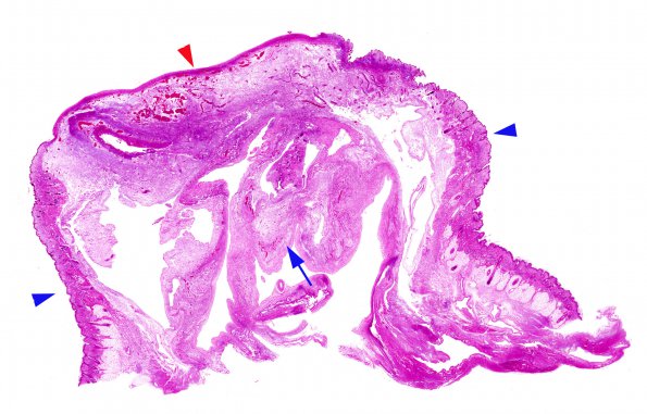 1C1 Encephalocele & Complex Malformation (Case 1) H&E repeat whole mount