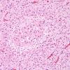 1C10 Encephalocele & Complex Malformation (Case 1) N9 cerebellum H&E 2