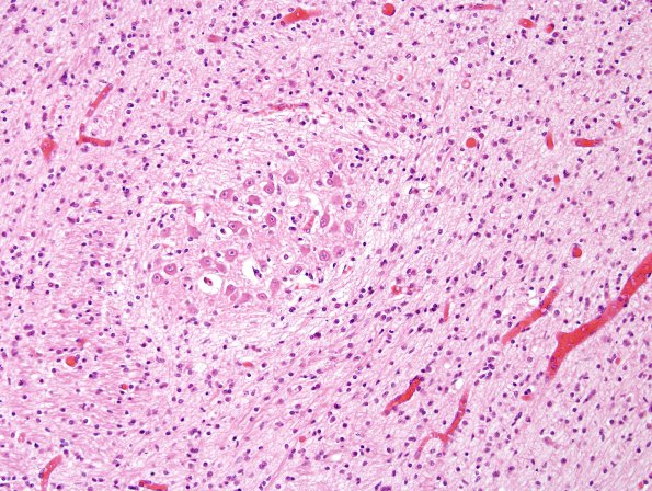 1C10 Encephalocele & Complex Malformation (Case 1) N9 cerebellum H&E 2