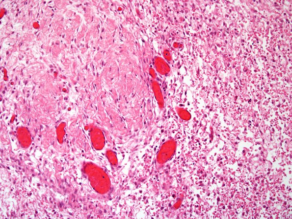 1C2 Encephalocele & Complex Malformation (Case 1) H&E whole mount