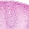 1C4 Encephalocele & Complex Malformation (Case 1) N11 H&E 2