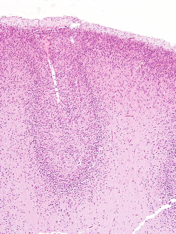 1C4 Encephalocele & Complex Malformation (Case 1) N11 H&E 2