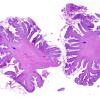 1C5 Encephalocele & Complex Malformation (Case 1) N9 H&E whole mount