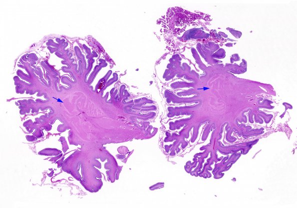 1C5 Encephalocele & Complex Malformation (Case 1) N9 H&E whole mount