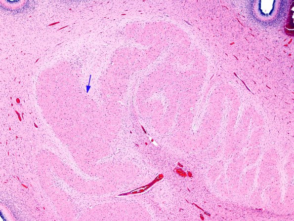 1C7 Encephalocele & Complex Malformation (Case 1) N9 H&E 9A