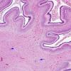 1C8 Encephalocele & Complex Malformation (Case 1) N9 H&E 4