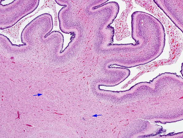 1C8 Encephalocele & Complex Malformation (Case 1) N9 H&E 4