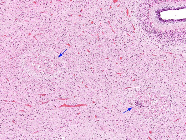 1C9 Encephalocele & Complex Malformation (Case 1) N9 H&E 3