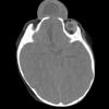 2A1 Encephalocoele & Complex Malformation (Case 2) CT 1