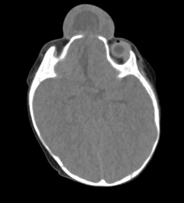 2A1 Encephalocoele & Complex Malformation (Case 2) CT 1