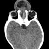 2A2 Encephalocoele & Complex Malformation (Case 2) CT 5