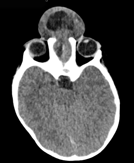 2A2 Encephalocoele & Complex Malformation (Case 2) CT 5