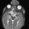 2A3 Encephalocoele & Complex Malformation (Case 2) T2 HASTE 3