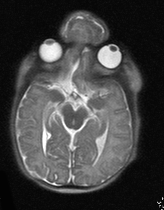 2A3 Encephalocoele & Complex Malformation (Case 2) T2 HASTE 3