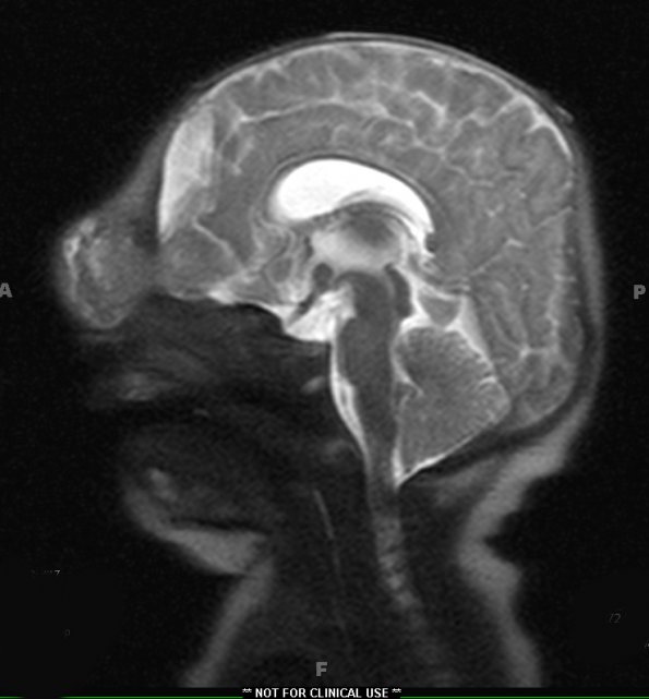 2A4 Encephalocoele & Complex Malformation (Case 2) T2 HASTE 4