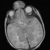 2A5 Encephalocoele & Complex Malformation (Case 2) T2