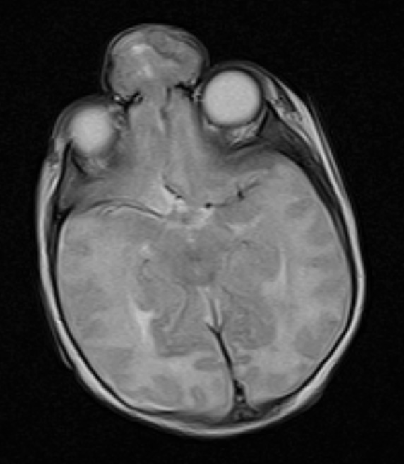 2A5 Encephalocoele & Complex Malformation (Case 2) T2