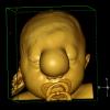 2A6 Encephalocoele & Complex Malformation (Case 2) Color Volume Movie 1