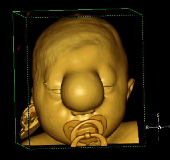 2A6 Encephalocoele & Complex Malformation (Case 2) Color Volume Movie 1