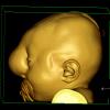 2A7 Encephalocoele & Complex Malformation (Case 2) Color Volume Movie 2