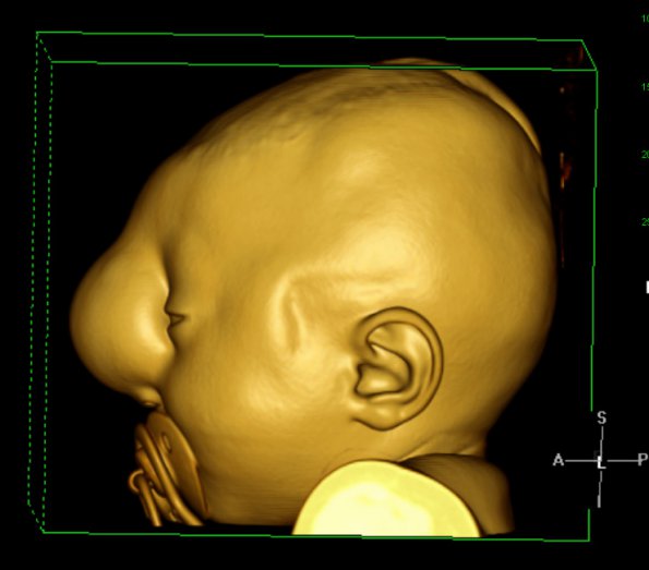 2A7 Encephalocoele & Complex Malformation (Case 2) Color Volume Movie 2