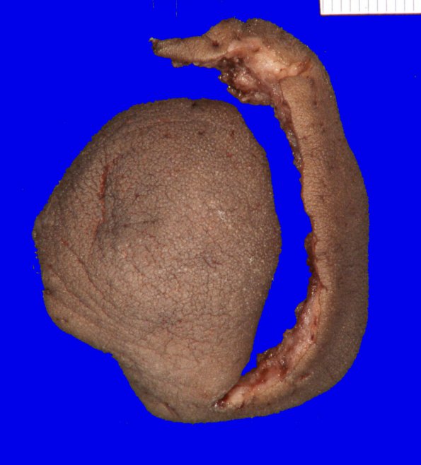 2B1 Encephalocoele & Complex Malformation (Case 2) _1A