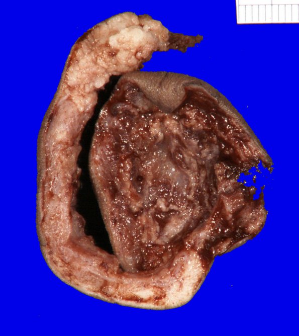 2B2 Encephalocoele & Complex Malformation (Case 2) _2A