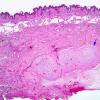 2C1 Encephalocoele & Complex Malformation (Case 2) 2X 1