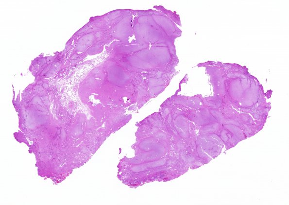 2C2 Encephalocoele & Complex Malformation (Case 2) H&E A8 whole moun