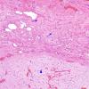 2C3 Encephalocoele & Complex Malformation (Case 2) A8 H&E 2