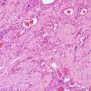 2C5 Encephalocoele & Complex Malformation (Case 2) A8 H&E 8