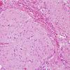 2C6 Encephalocoele & Complex Malformation (Case 2) A8 H&E 13